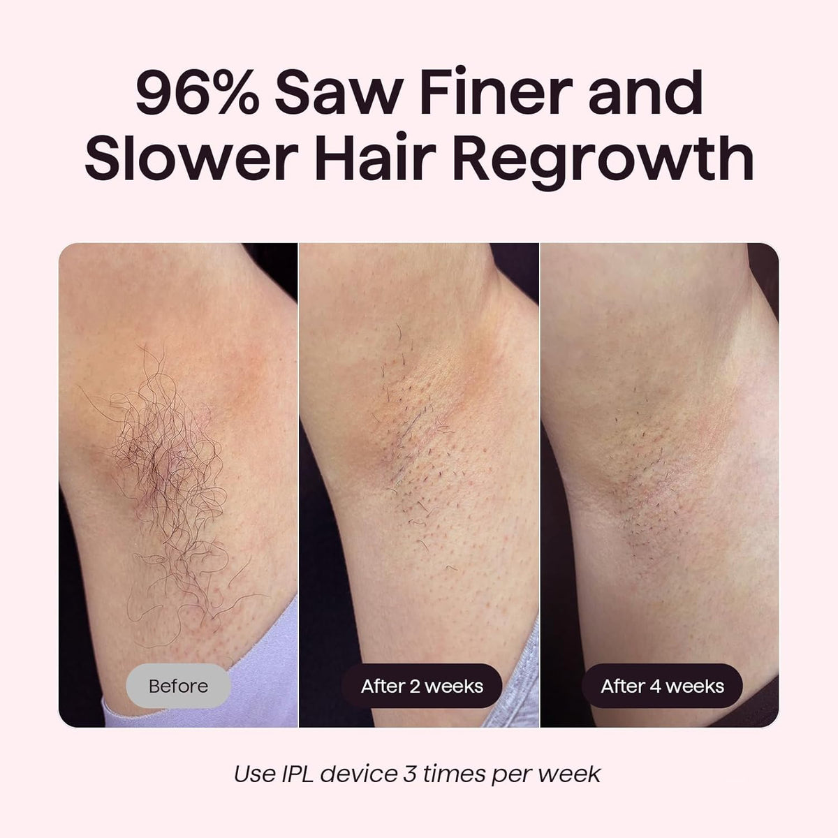 Salon-Quality Hair Removal