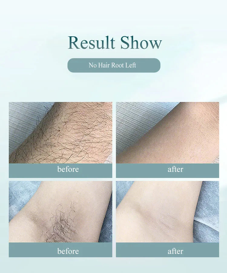 Safe & Painless Hair Removal