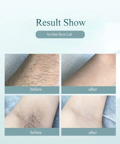 Safe & Painless Hair Removal