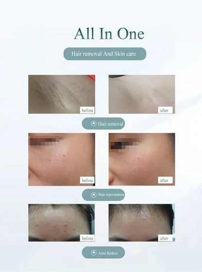 Safe & Painless Hair Removal