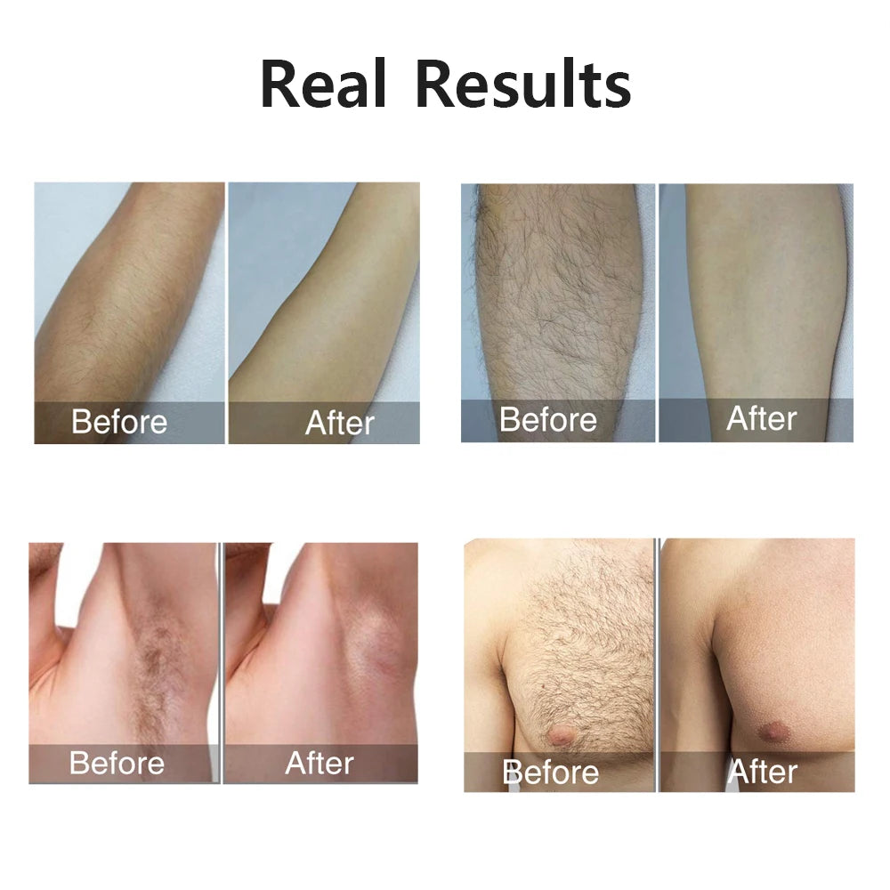 Permanent Hair Removal for Body