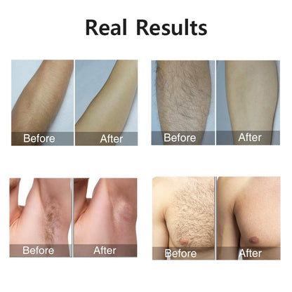 Permanent Hair Removal for Body